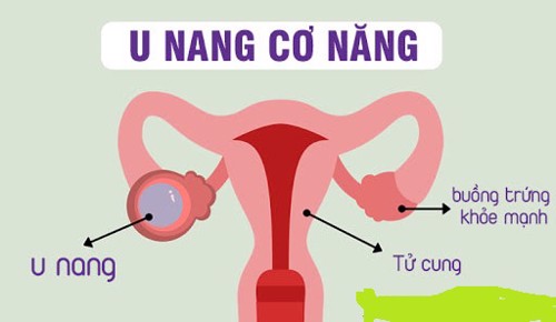 U nang cơ năng buồng trứng là gì? Mách bạn thảo dược giúp cải thiện bệnh nhanh chóng